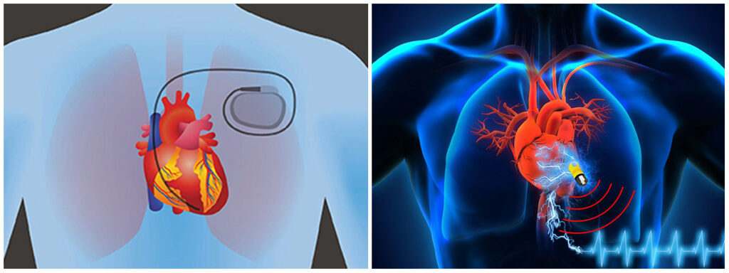 what-is-a-pacemaker-of-the-heart-dr-bikash-majumder