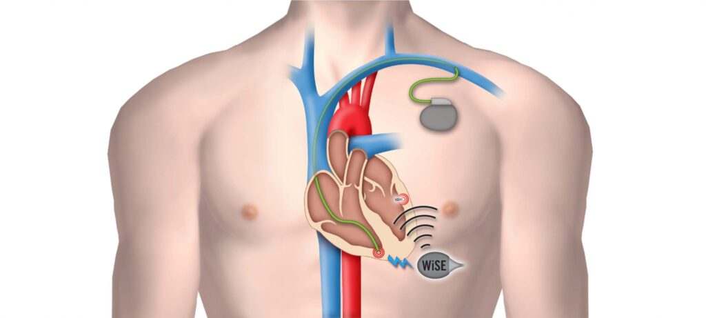 What Is A Pacemaker Of The Heart Dr Bikash Majumder