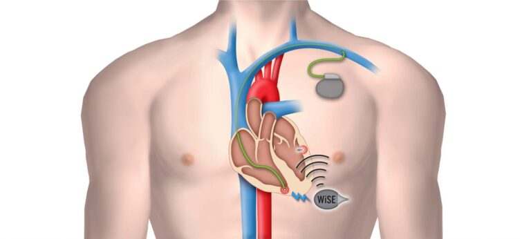 how is a pacemaker attached to the heart