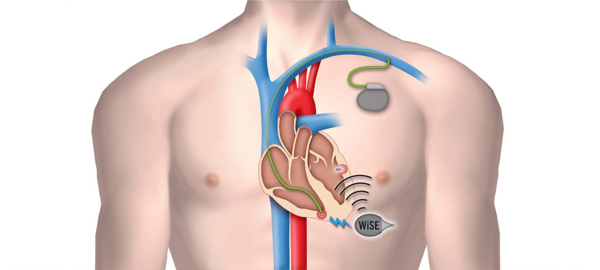 WHAT IS A PACEMAKER OF THE HEART?